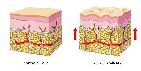 Cellulite, Orangenhaut